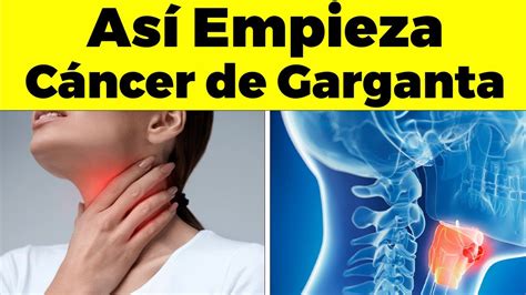 cancer de garganta sintomas
